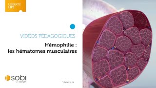 Hémophilie - Les hématomes musculaires