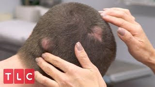 Brandon Has Bumps All Over His Head | Dr. Pimple Popper
