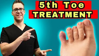 What To Do For A Broken Pinky Toe [How To Tape & Little Toe Treatment]
