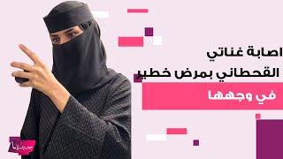 اصابة غناتي القحطاني بمرض خطير في وجهها وطبيبة تكشف سبب صادم لما حدث معها