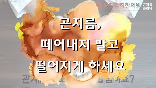 [3분요약] 곤지름 재발 안 하는 방법