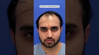 💥Unbelievable Hair Transplant Results by Perfect-i Technique💥 #shorts #shortsfeed #viral