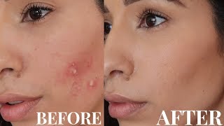 HOW I GOT RID OF TEXTURED SKIN | MY SKIN CARE ROUTINE FOR CLEAR SKIN