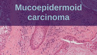 Mucoepidermoid Carcinoma of Salivary Glands - Pathology mini tutorial