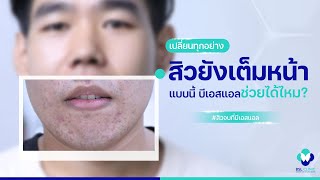 รักษาสิว | EP.122 | สิว ขึ้นเต็มหน้า ลองเปลี่ยนทุกอย่าง ไม่เท่าเจอคลินิกรักษาสิวที่ดี | BSL Clinic