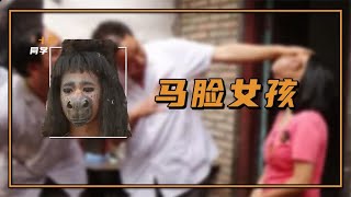 22岁的花季少女长了一张“马脸”蒙面13年不敢见人，如今她怎样了