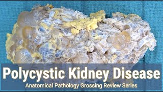 Polycystic Kidney Disease | Anatomical Pathology Grossing Review Series