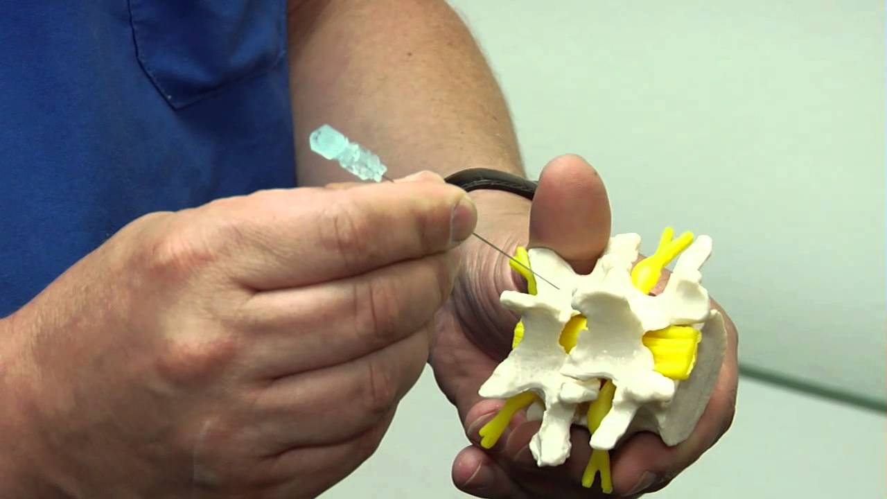 Epidural Steroid Injection Back Pain Vrogue Co Epidural Steroid Injection Back Pain Vrogue Co