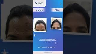 hairloss treatment | hairfall treatment| Vtiara Hair \u0026 Skin Clinic | Newbel Road | Indiranagar |