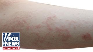 What is scabies? How an itch can turn deadly