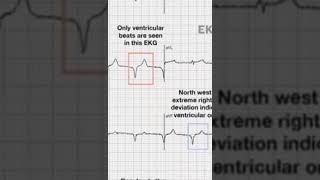 AIVR on ECG characteristic features and treatment options.