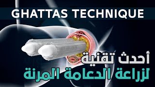 أحدث تقنية لزراعة الدعامة المرنة - Ghattas Technique