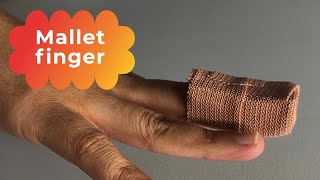 Mallet finger - a Zone 1 finger extensor tendon injury