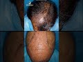 hair transplant in chennai amazing results before and after tamira plastic surgery shorts