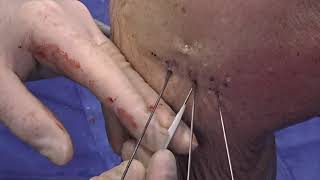 Medial Meniscotibial Ligament Repair Using PEEK Knotless SutureTak® Anchors