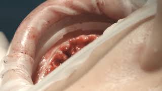 Multi Neo Implant Drilling séquence par le Dr Victor Cubillo