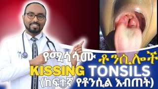 ከፍተኛ የቶንሲል እብጠት  መንስኤዎቹና ህክምናው | Tonsillar hypertrophy causes and treatment.