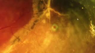 Demarcation lines \u0026 spontaneously attached retinal detachment