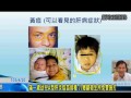 滿一歲幼兒a型肝炎疫苗接種 八鄉鎮衛生所免費施打