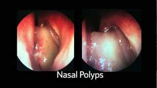 AAO-HNSF The ENT Exam Episode 4: The Nasopharynx and Larynx Exam