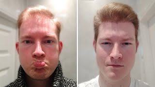 He Destroyed His Hair Loss With Minoxidil And Finasteride