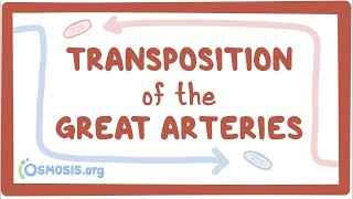 Transposition of the great arteries (TGA) - causes, symptoms, treatment & pathology