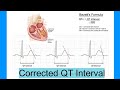 corrected QT Interval