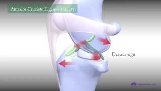 犬の前十字靱帯断裂 / ACL (Cranial Cruciate Ligament)