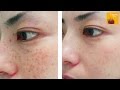 Amazing Freckles Removing Homemade Solution - 100% Results!