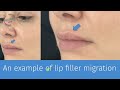 lip fillers dos don ts and faqs dr. obt explains angel lips technique