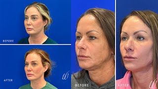 The Collagen Comeback: Why Sculptra is the Talk of Aesthetics