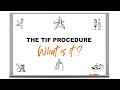 The TIF Procedure: What is it?