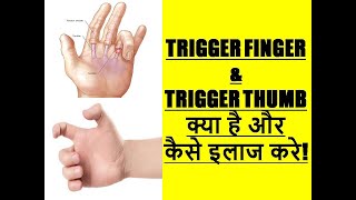 Trigger Finger Trigger Thumb (Hindi) ऊँगली  अटकना अंगूठा अटकना | How to Treat Trigger Finger Fast|