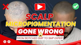 Scalp Micropigmentation Gone Wrong   From Botched SMP To SMP Expert   Ivan Alvarado