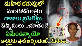 మహిళ కడుపులో మంగళసూత్రం గాజులు,బ్రసెలెట్లు పిన్నీసులు చూడండి ఏమేంఉన్నాయో డాక్టర్లకు షాక్ ఇచ్చింద