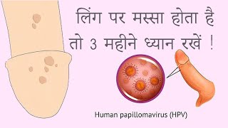 Warts - HPV : लिंग पर मस्सा होता है तो 3 महीने ध्यान रखें !