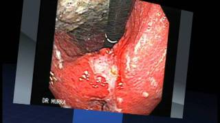 Gastric Cancer