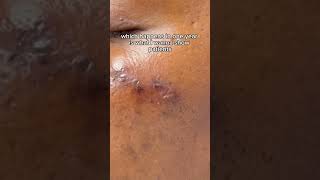 SCAR REVISION RESULTS (ONE MONTH POST-OP) - DR. TANVEER JANJUA - NEW JERSEY