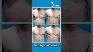 Gynecomastia Surgery Result !! Grade 2A Gynecomastia Before After #gynecomastia360