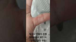 영상 보다 좀 더 심각함 흉터 남 #달고나 #화상 #sad #떡상기원