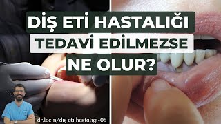 Diş Eti Hastalığı Tedavi Edilmezse Ne Olur ? | Gingivitis ve Periodontitis | Diş Eti Hastalıkları-05