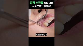 교정을 위해 잇몸에 나사를 박는다고요?!?! #shorts