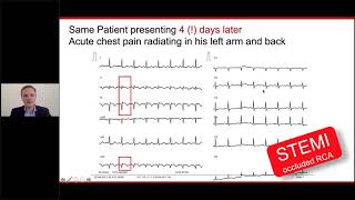 Clinical use of high sensitivity cardiac troponin and the ESC 0 1h algorithms