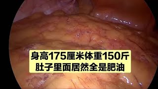 身高175厘米体重150斤，就是肚子大一点，里面居然全是肥油