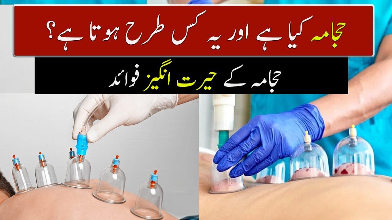 What Is Cupping Therapy (Hijama) And How Is It Done? | Geo Digital ...