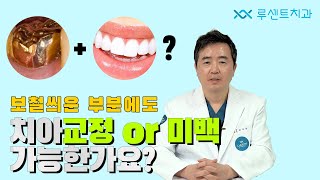 [보철Q\u0026A] 보철치료한 치아에도 치아교정, 미백이 가능한가요?