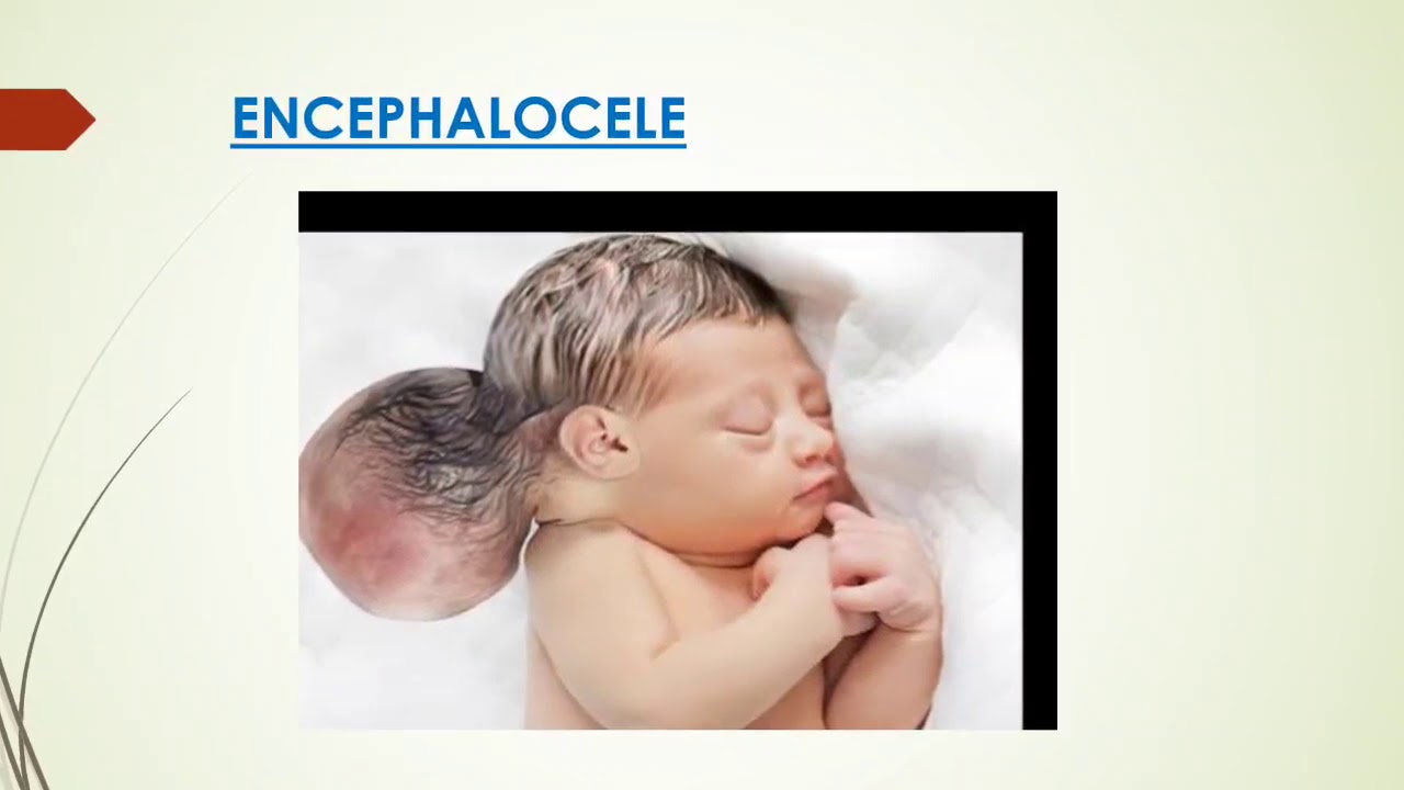 NEURAL TUBE DEFECT - YouTube