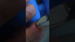 Cutting and fixing an ingrown toenail. #ingrown_toenail #ingrown_toenail_surgery