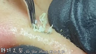 閉鎖粉刺處理(Atresia acne treatment)-Taiwan New Taipei City-台北清粉刺最乾淨