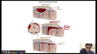 Epidural/subdural hematomas and suture lines